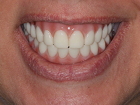 avoiding the double gum in full arch implant