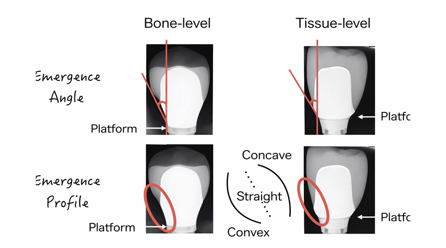 feature_emergence angle emergence angle and profile in peri-implant health