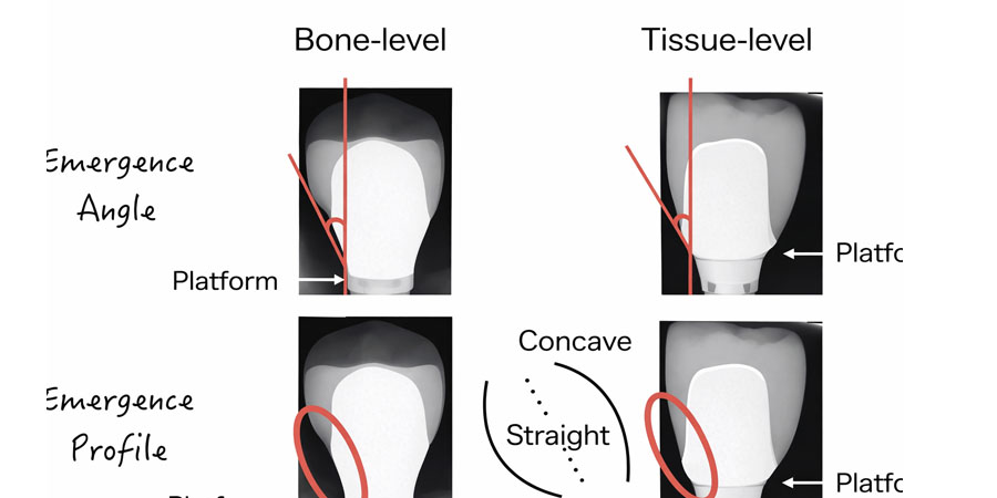 hypothesis to evidence Emergence angle and profile in peri-implant health