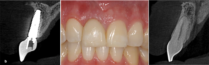 narrow buccal gap narrow buccal gap