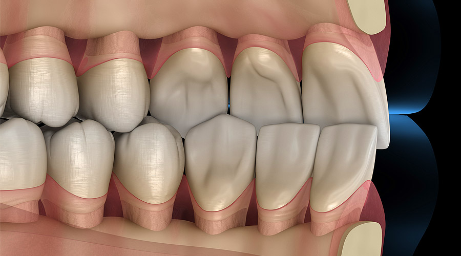 occlusion