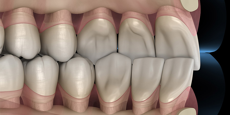 occlusion