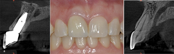 wide buccal gap wide buccal gap